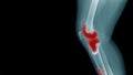 X-ray image of OA knee with banner design Royalty Free Stock Photo