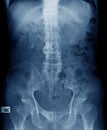 x-ray image of old man show ankylosing spondylitis or bamboo spine Royalty Free Stock Photo
