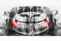X-ray image of oral cavity with growing lower wisdom teeth on white background Royalty Free Stock Photo