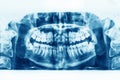 X-ray image of oral cavity with growing lower wisdom teeth on white background Royalty Free Stock Photo