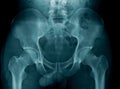 X-ray image pelvic bone and hip joint Royalty Free Stock Photo