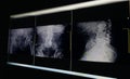 x-ray image pelvic bone and hip joint, degenerative change L4-5 lumbar Scoliosis film x-ray lumbar spine AP, Lateral Royalty Free Stock Photo