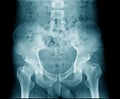 X-ray image pelvic bone and hip joint