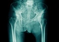 X-ray image pelvic bone and part of l-spine with compression of spine