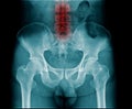 X-ray image of pelvic bone and part of lumbar spine