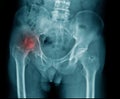 X-ray image of pelvic bone and show avascular necrosis at hip Royalty Free Stock Photo