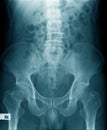 Lumbar spine x-ray image Royalty Free Stock Photo