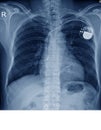 X-ray image of permanent pacemaker implant in chest body , process in blue tone Royalty Free Stock Photo
