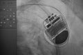 Permanent pacemaker implantation in patient