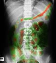 X-ray image of plain abdomen supine.