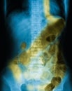 X-ray image of plain abdomen supine. Royalty Free Stock Photo