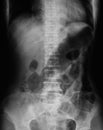 X-ray image of plain abdomen.