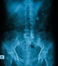 X-ray image of plain KUB. Royalty Free Stock Photo