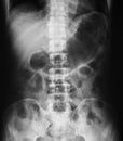 X-ray image of plan abdomen.