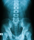 X-ray image of Plan KUB. Royalty Free Stock Photo