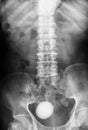 X-ray image of Plan KUB, supine view.