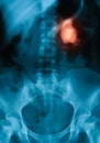 X-ray image of Plan KUB, supine view. Royalty Free Stock Photo