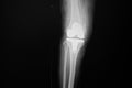 X-ray image of lanteroposteriorright knee joint with total knee replacement.