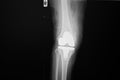 X-ray image of lanteroposteriorright knee joint with total knee replacement. Royalty Free Stock Photo