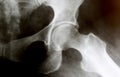 X-Ray image of regular hip joint