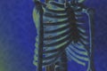 X-ray image of the rib of man. Royalty Free Stock Photo