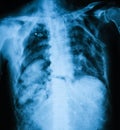 X-ray image of ribs, AP view. Royalty Free Stock Photo