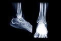 x-ray image of right ankle joint AP and Lateral view.