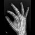 X-ray image of right hand oblique view Royalty Free Stock Photo