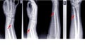 X-ray image right of wrist joint, shows fracture of the distal radius and ulna