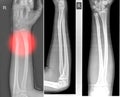 X-ray image right of wrist joint, shows fracture of the distal radius and ulna
