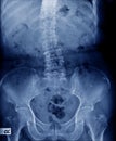 X-ray image scoliosis and spondylosis human spine