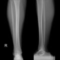 X-ray image of shin , Frontal Sagital view normal.