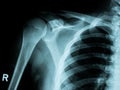 X-ray image of shoulder fracture for a medical diagnosis