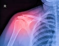 X-ray image of shoulder pain, shoulder ligament tendinitis, shoulder muscle strain