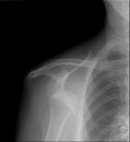 X-ray image of shoulder, Shows left shoulder dislocation. anterior projection Royalty Free Stock Photo