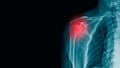 X-ray image of shoulder