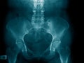 x-ray image show pelvic bone