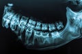 An x-ray image showing a dental arch with multiple teeth missing, High resolution X-ray film of the jawbone, AI Generated