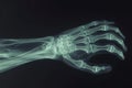 An x-ray image showing the skeletal structure of a hand with a superimposed skeleton, A 3D X-ray of a human wrist with a fracture Royalty Free Stock Photo