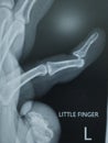 X-ray image shows dislocation of the proximal joint of Left little finger.