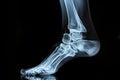 This x-ray image shows the skeletal structure of a foot with a visible bone, Ankle and foot in a single X-ray projection, AI Royalty Free Stock Photo