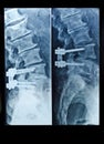 X-Ray image of spinal column with screws after surgery