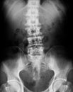 X-ray image of spine, AP view.