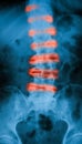 X-ray image of spine. AP view.