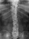 X-ray image of the spine bones Royalty Free Stock Photo