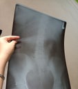 an x-ray image of the spine that has narrowed spaces between the bones. Royalty Free Stock Photo