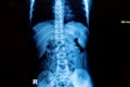 X-ray image spine and pelvis Royalty Free Stock Photo