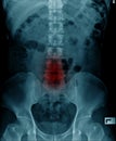 X-ray image of spine show degeneration of lumbar