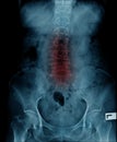 X-ray image of spine