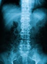 X-ray image of T-L spine, APview.